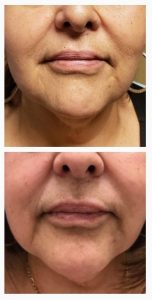 Patient had barbed Thread-lift by pulling back back the nasolabial folds and jowls.