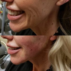 Patient had thread face-lift to help her jowls and smile lines. After picture was taken immediately afterwards.