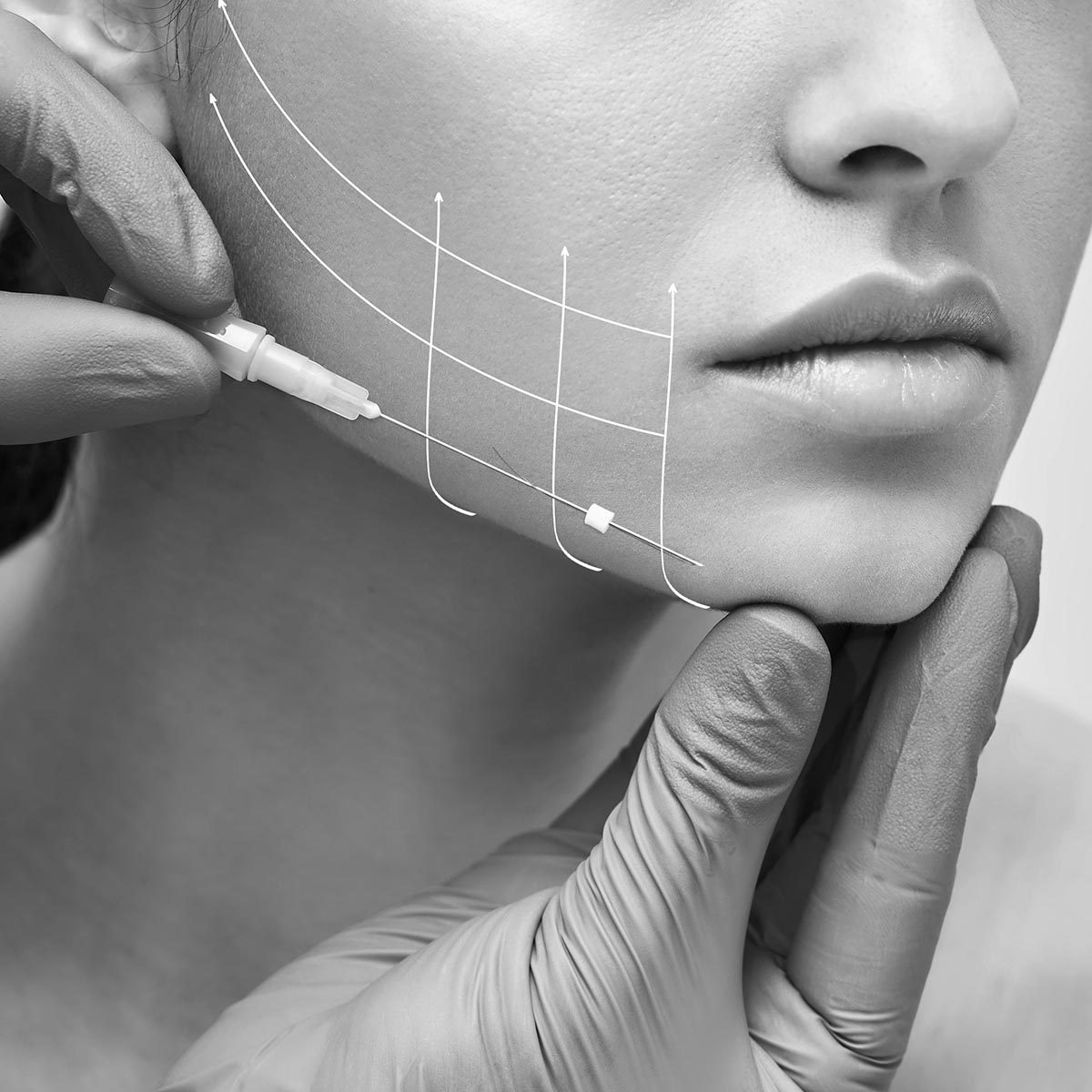 Facial lifting thread. Thread facelift with arrows on face for woman's skin, procedure facial contouring using mesothreads
